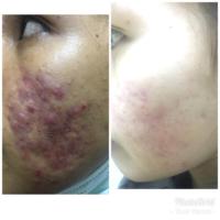Acne Treatment (2)